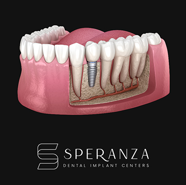 Zirconia Implant Bridge