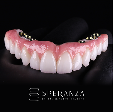 Hybrid Implant Bridge