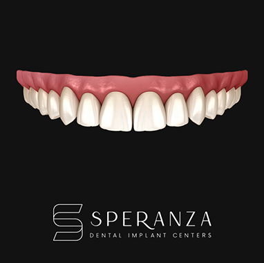 Porcelain Implant Bridge